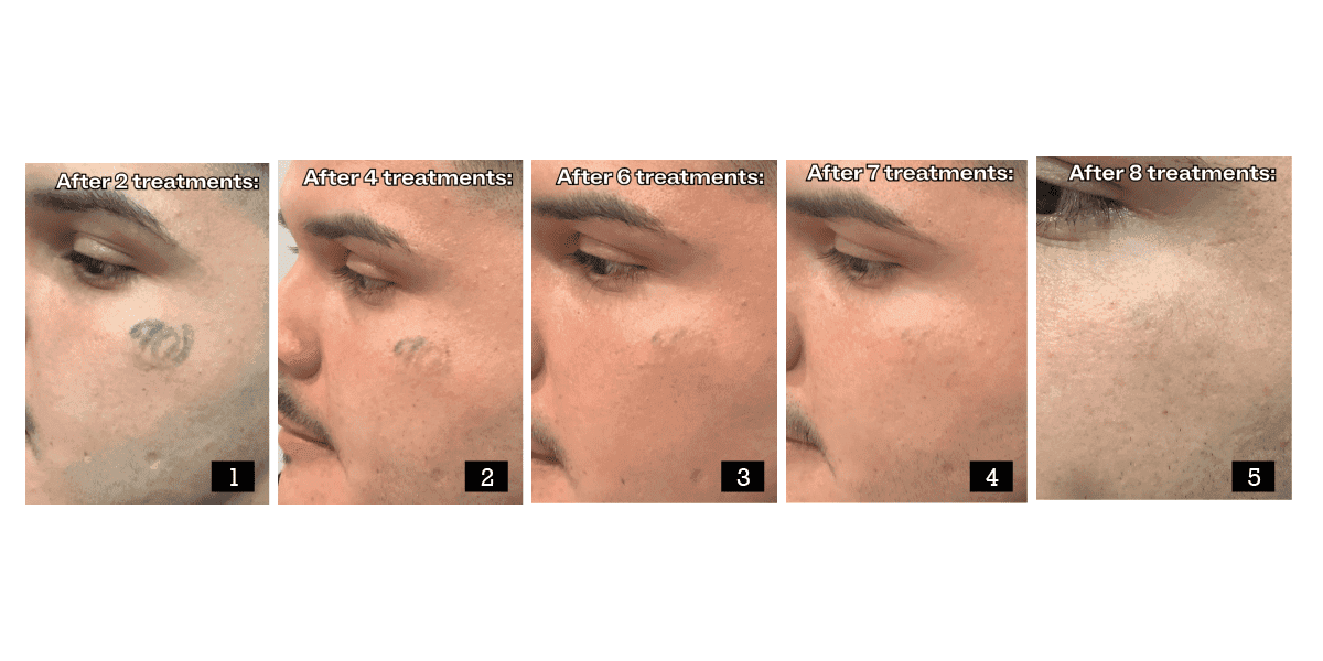 Tattoo Removal Before and After — What Results Actually Look Like 2026
