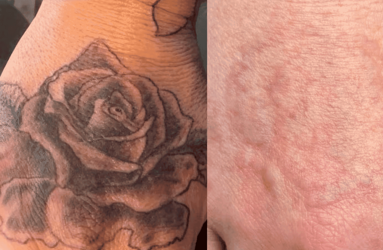 Skin After Tattoo Removal — What's Normal and What Isn't