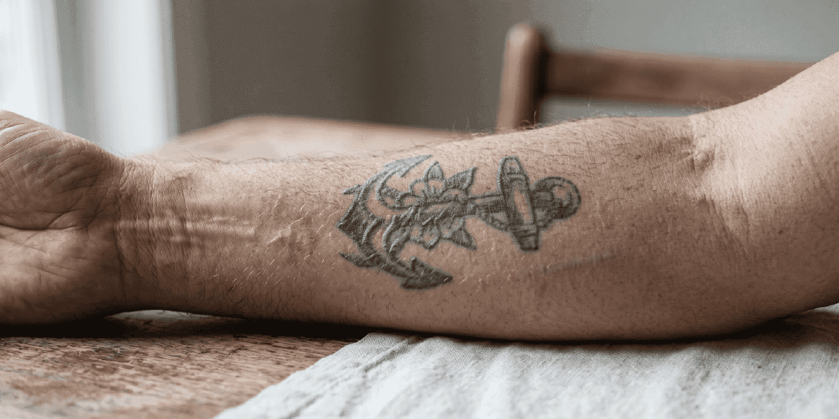 Tattoo Removal Scars — Will Laser Leave a Mark